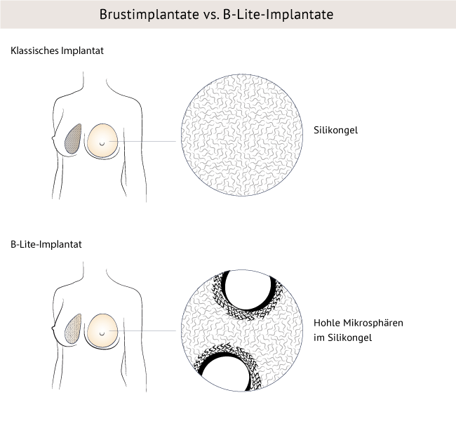 Illustration B-Lite-Implantat Brustvergrößerung Nürnberger Klinik Dr. Baetge 