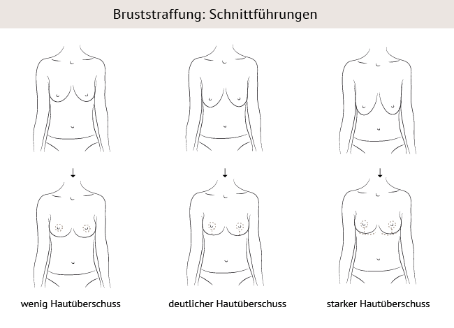 Bruststraffung in Nürnberg 