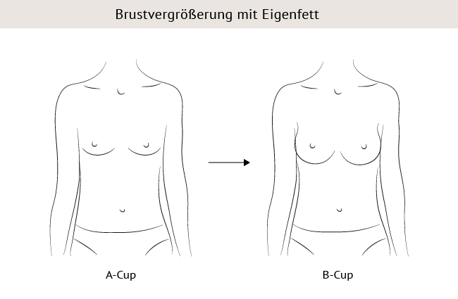 Brustvergrößerung a auf b