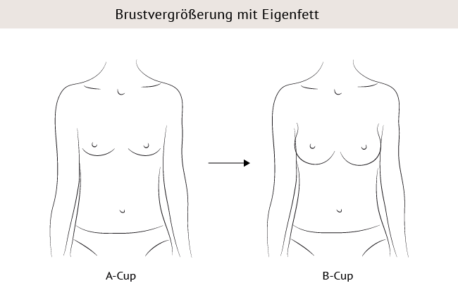 B körbchen vorher nachher brustvergrößerung 350cc vorher