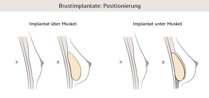 Brustvergrößerung mit Implantaten in Nürnberg