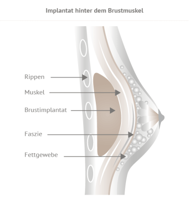 Grafik Implantat hinter Brustmuskel 